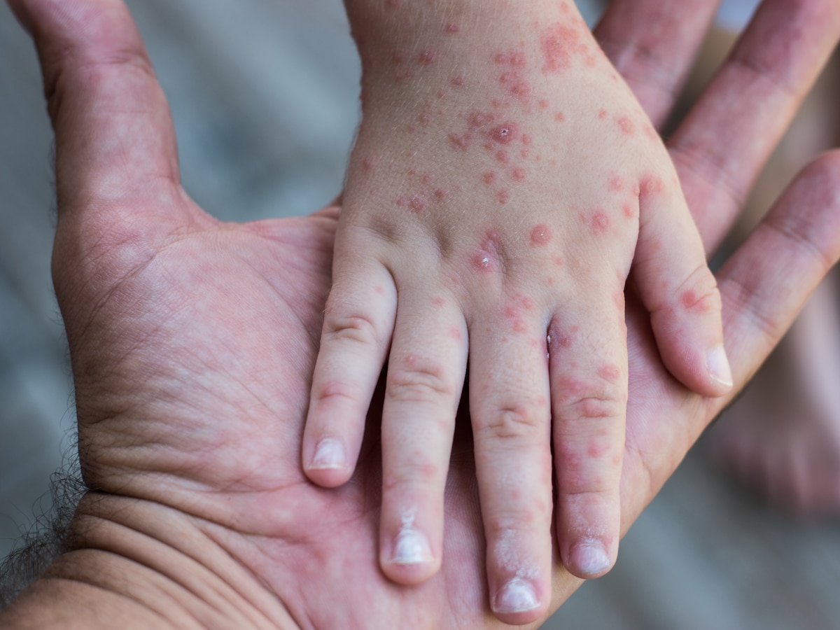 Qué es el virus de coxsackie, enfermedad que provocó el cierre de escuelas de manera temporal en el Edomex - Infobae