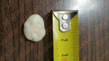 Se operó una rodilla, le olvidaron una cánula de drenaje adentro y tuvo que someterse a otras dos cirugías: condenaron al médico y al sanatorio
