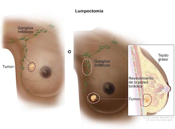 El cáncer de mama afecta principalmente a mujeres entre 45 y 60 años. (FOTO: National Cancer Institute)