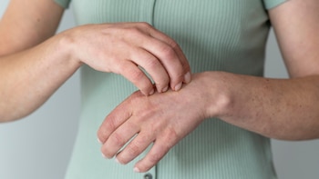 Un médico explica qué son las pequeñas ampollas que salen a veces en la palma de la mano o entre los dedos: “No es alergia y tampoco es contagioso”