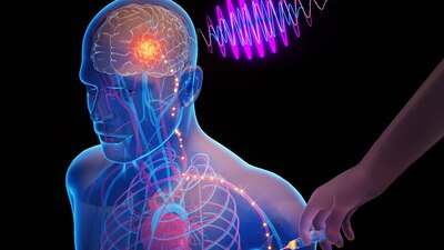 Chips inyectables autoimplantables ofrecen esperanza para trastornos cerebrales