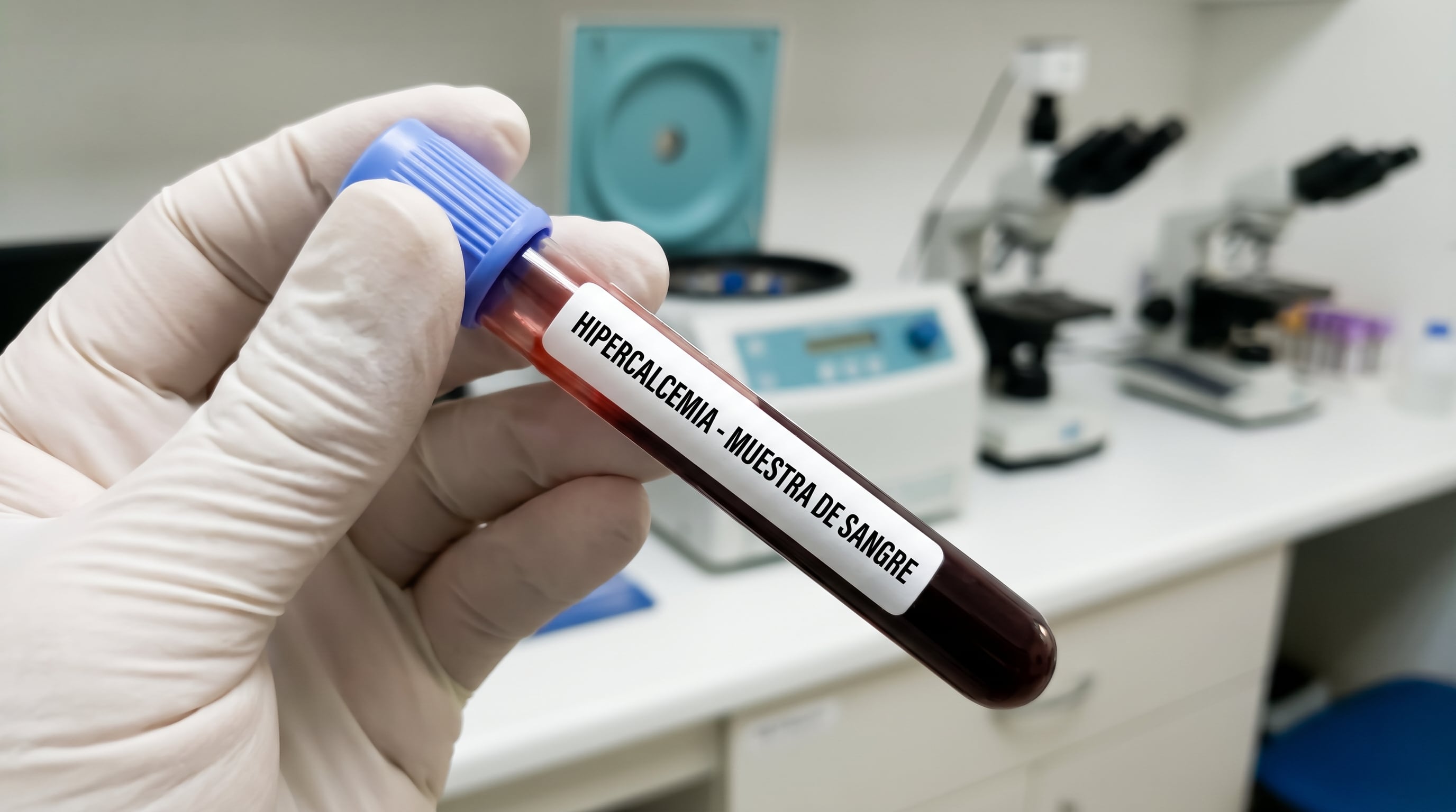 El diagnóstico de hipercalcemia se confirma con análisis de sangre y el tratamiento puede incluir suspender suplementos, aumentar líquidos, cirugía paratiroidea o diálisis según la causa (Imagen Ilustrativa Infobae)