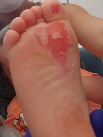 Las ampollas y la piel