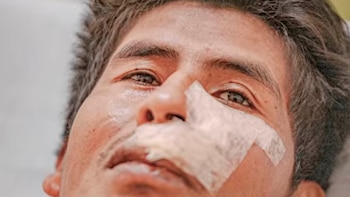 Alejandro Pérez convivió durante 14 años con un osteofibroma en el rostro que llegó a dificultarle la alimentación (Captura de video: YouTube)