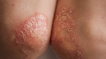 Nueva píldora podría cambiar el tratamiento de la psoriasis