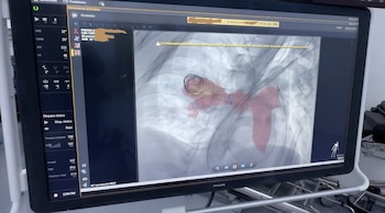 Una angiotomografía computarizada reveló una lesión de gran tamaño. (CSS)