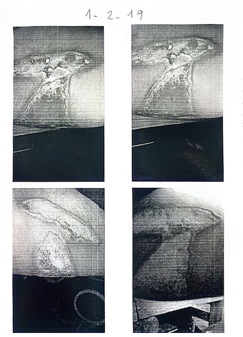 Fotos de las quemaduras de