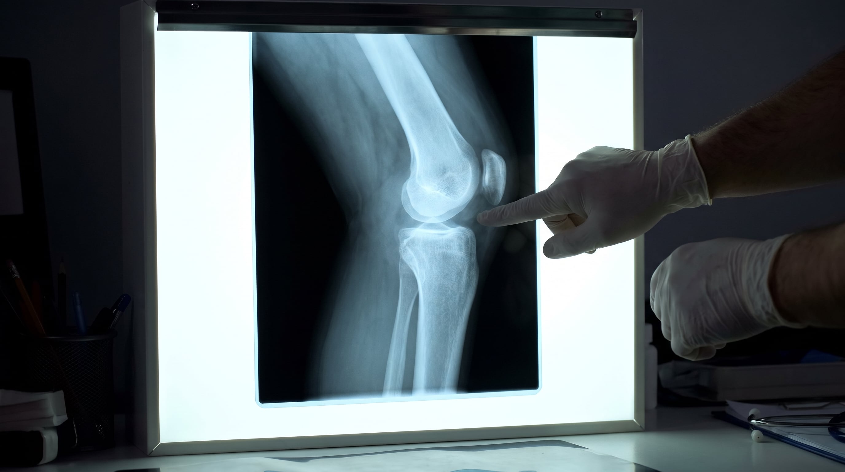 La mayoría de los tumores óseos detectados en estudios por imágenes resultan ser benignos según Mayo Clinic (Imagen Ilustrativa Infobae)