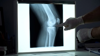 La mayoría de los tumores óseos no son cancerosos, según una oncóloga de Mayo Clinic