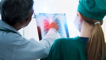 Descubren el origen de un cáncer de pulmón difícil de tratar y abren la puerta a terapias más precisas