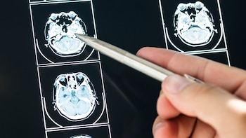 Hallan unas células hasta ahora desconocidas en el cerebro de los pacientes con Alzheimer