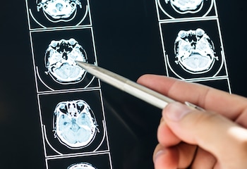 Resultados de escáner cerebral (Magnific)