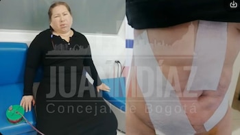 Jenniffer Johana Guevara denunció que una lipólisis láser y una perfiloplastia supervisadas por Gabriel Cubillos le causaron quemaduras, lesiones en el cuello e inflamación crónica - crédito @juanmdiazma / X