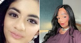 Sobrevivió a graves quemaduras tras un accidente con una loción para la pediculosis y hoy ayuda con su testimonio en las redes