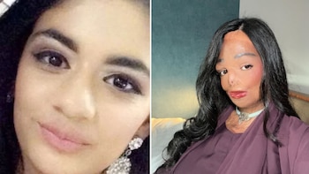 Sobrevivió a graves quemaduras tras