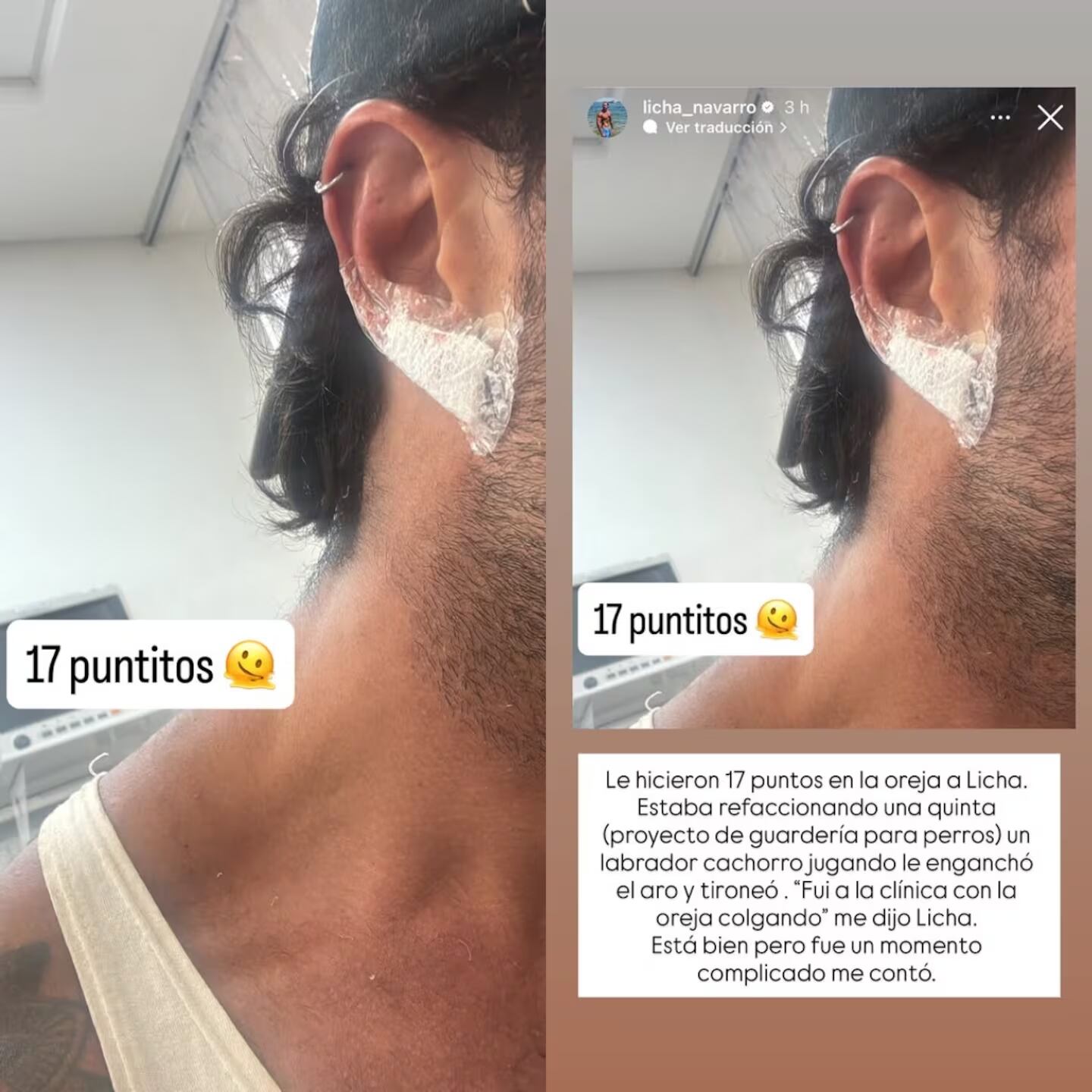 El ex Gran Hermano 2023 mostró en Instagram la impactante imagen de su oreja vendada, lo que generó gran preocupación entre sus seguidores