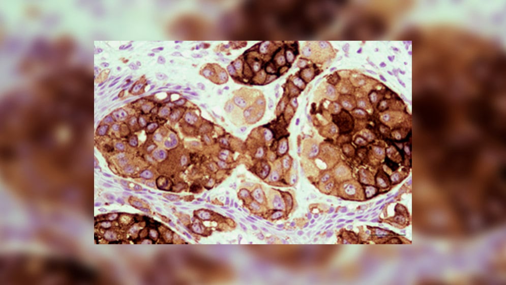 La primera aprobación de esta inmunoterapia personalizada podría llegar en melanoma y extenderse luego a tumores de pulmón, riñón, vejiga y carcinoma escamoso. (Conicet)