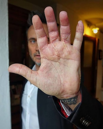 Nek mostró las cicatrices del