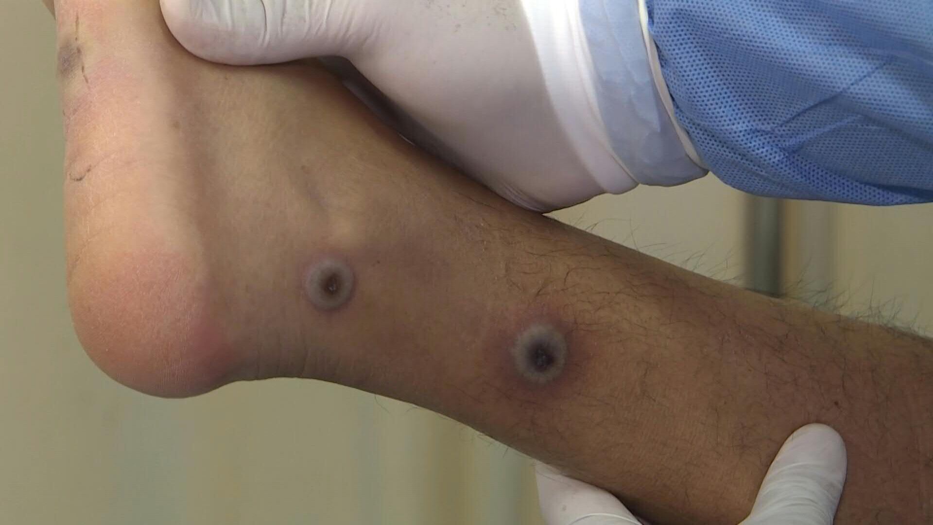 La región de América se ha convertido en el epicentro del brote de viruela del mono, con la mayor cantidad de casos en el mundo, alertó el miércoles la Organización Panamericana de la Salud (OPS).