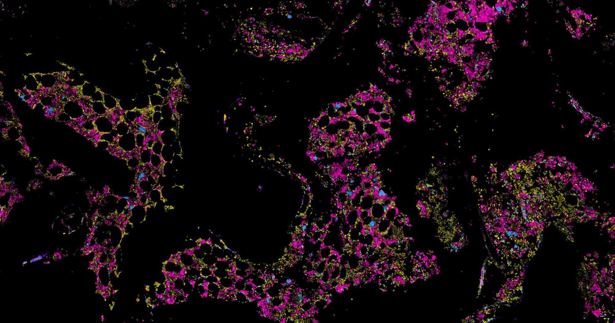 Un mapa molecular de la médula ósea abre la puerta a terapias más efectivas contra el mieloma múltiple