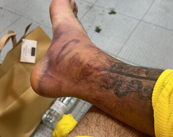 La foto de la lesión