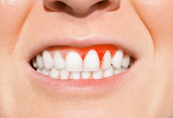 El escorbuto puede ser un