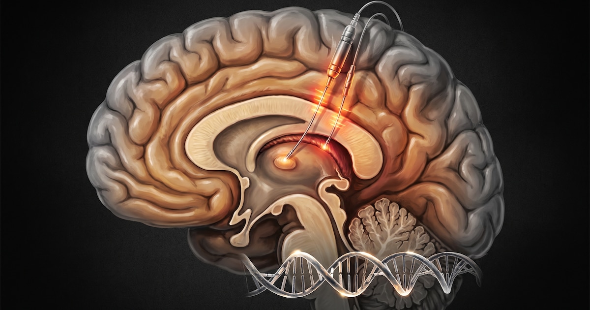 Parkinson y cirugía cerebral: por qué el momento de la intervención es clave para frenar el deterioro