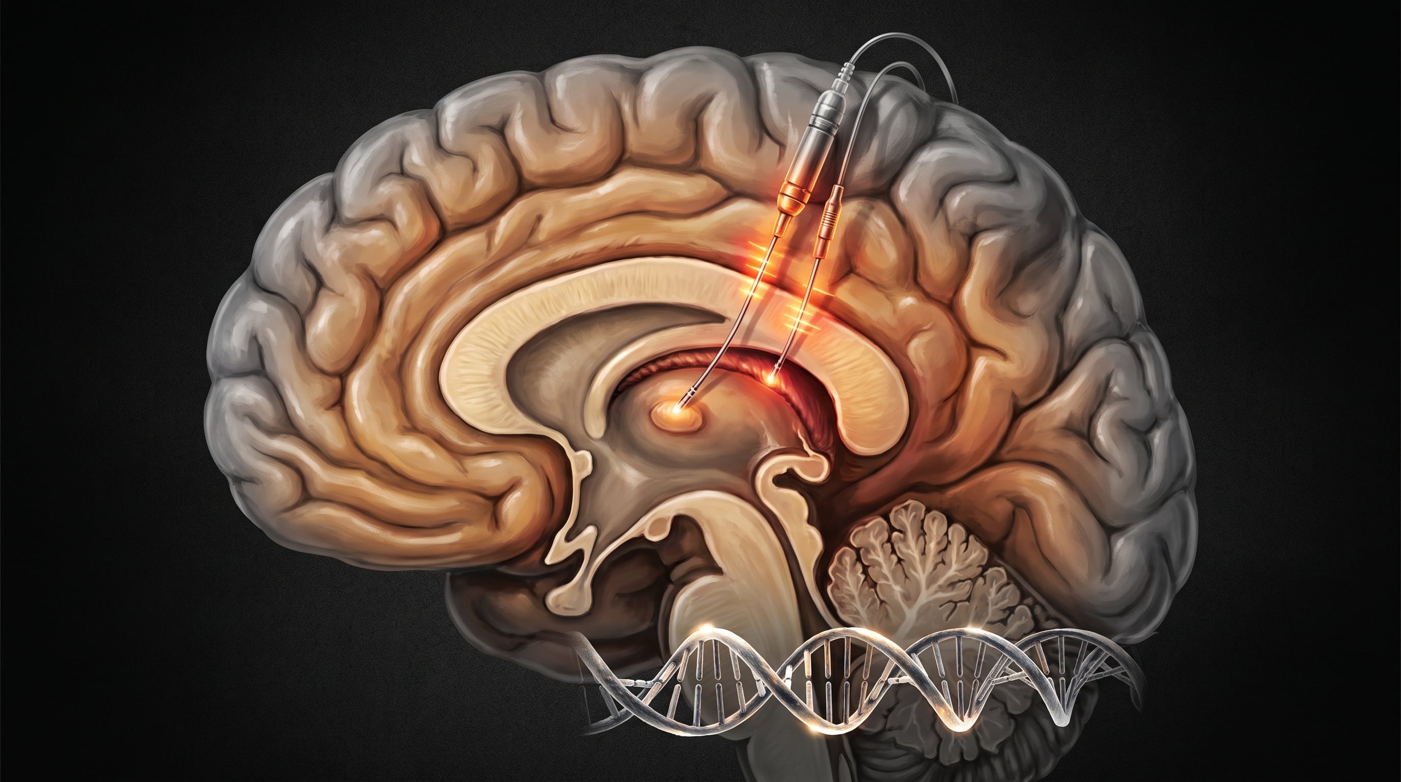 Parkinson y cirugía cerebral: por qué el momento de la intervención es clave para frenar el deterioro