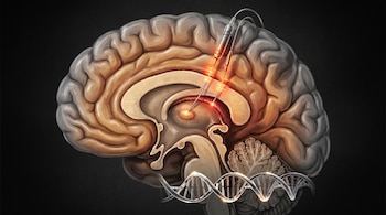 Corte transversal de un cerebro humano con electrodos de estimulación implantados y una cadena de ADN en la parte inferior sobre fondo negro.