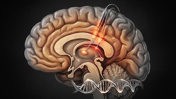 Parkinson y cirugía cerebral: por qué el momento de la intervención es clave para frenar el deterioro