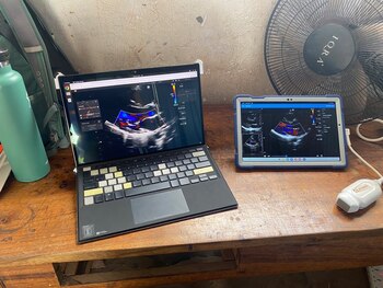 Un ecógrafo portátil y una