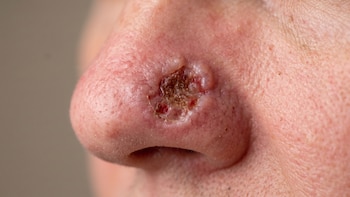 Epitelioma o carcinoma basocelular: qué es, cómo actuar y por qué es importante tratarlo a tiempo
