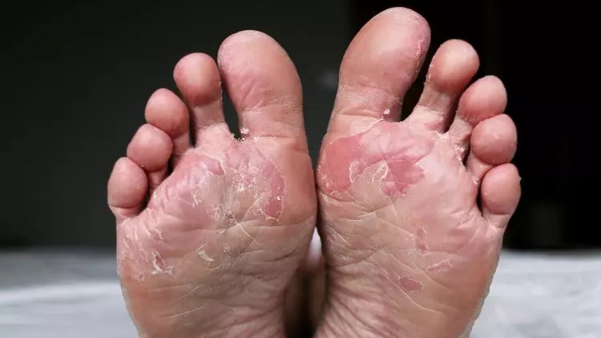 Pie de atleta: consejos para evitar esta y otras infecciones por hongos - Infobae