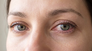 Primer plano de los ojos de una mujer con iris verdes. El ojo derecho está levemente enrojecido en la esclera, mostrando signos de irritación.