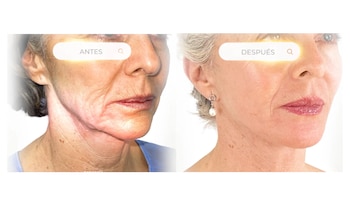 El antes y después de Margarita Rosa de Francisco tras someterse a una intervención para perfilar su rostro - crédito @margaritarosa.defrancisco/ Instagram