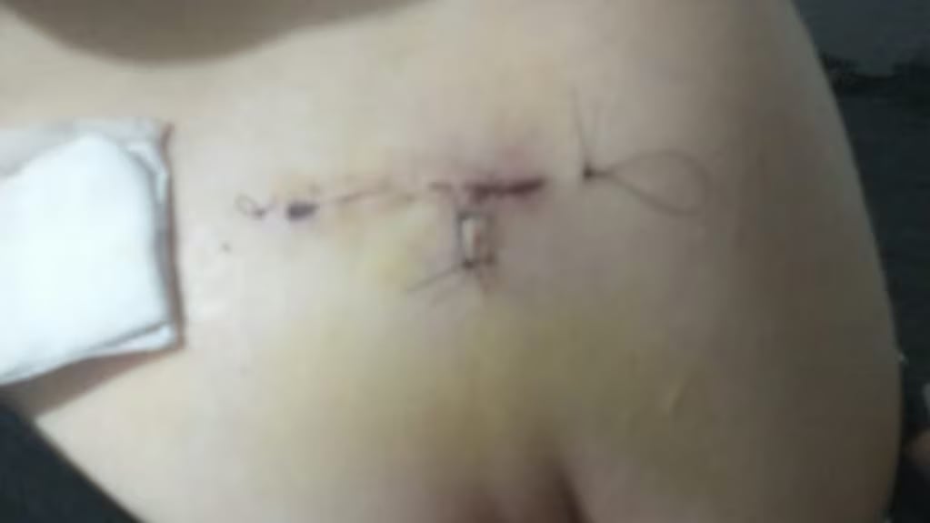 La herida que le quedó producto de la puñalada (Gentileza: El Doce)