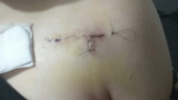 La herida que le quedó