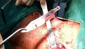 La intervención quirúrgica permitió extraer