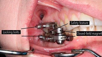 Los seguros y el dispositivo