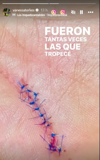 Vanessa Terkes mostró herida suturada.