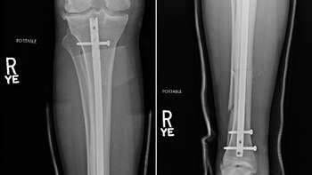 "Me pusieron una varilla de