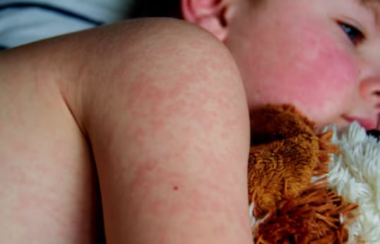 La vigilancia de aguas residuales revela un subregistro de casos, pero enfrenta obstáculos para identificar focos precisos y cuantificar el número real de infectados (Freepik)