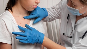 Casos de sarampión en México: