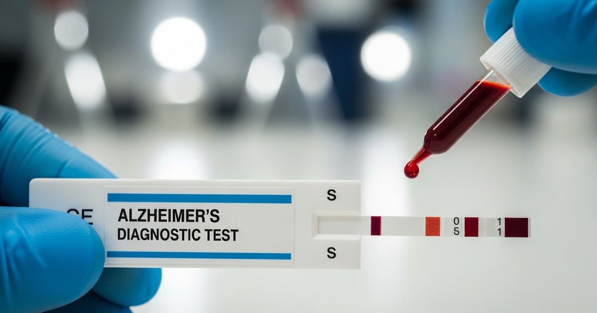 Roche lanza en Europa un test de sangre para detectar el Alzheimer
