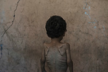 Yazan Abu Ful, un niño desnutrido de 2 años, posa para una fotografía en el hogar de su familia en el campamento Shati de refugiados, el miércoles 23 de julio de 2025, en Ciudad de Gaza (AP Foto/Jehad Alshrafi, archivo)