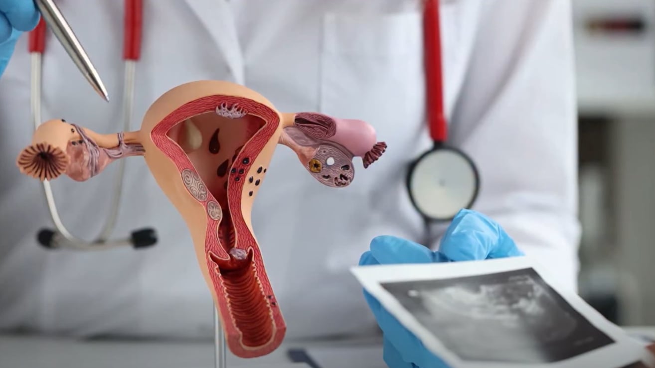 Cada año se registran 270 casos de cáncer de cérvix en el país; el Gobierno busca eliminarlo como problema de salud pública (Captura de video)