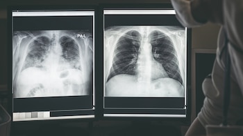 Cómo se hace una broncoscopia