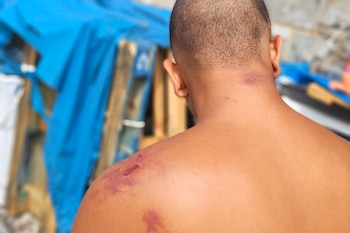 Un migrante en Ceuta muestra sus heridas, agredido por militares españoles, según Amnistía Internacional. (EFE/AI)