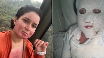 Mujer que fue prendida en fuego por la esposa de su pareja contó cómo sobrevivió al ataque: “Intentaron quitarme la vida mientras dormía”
