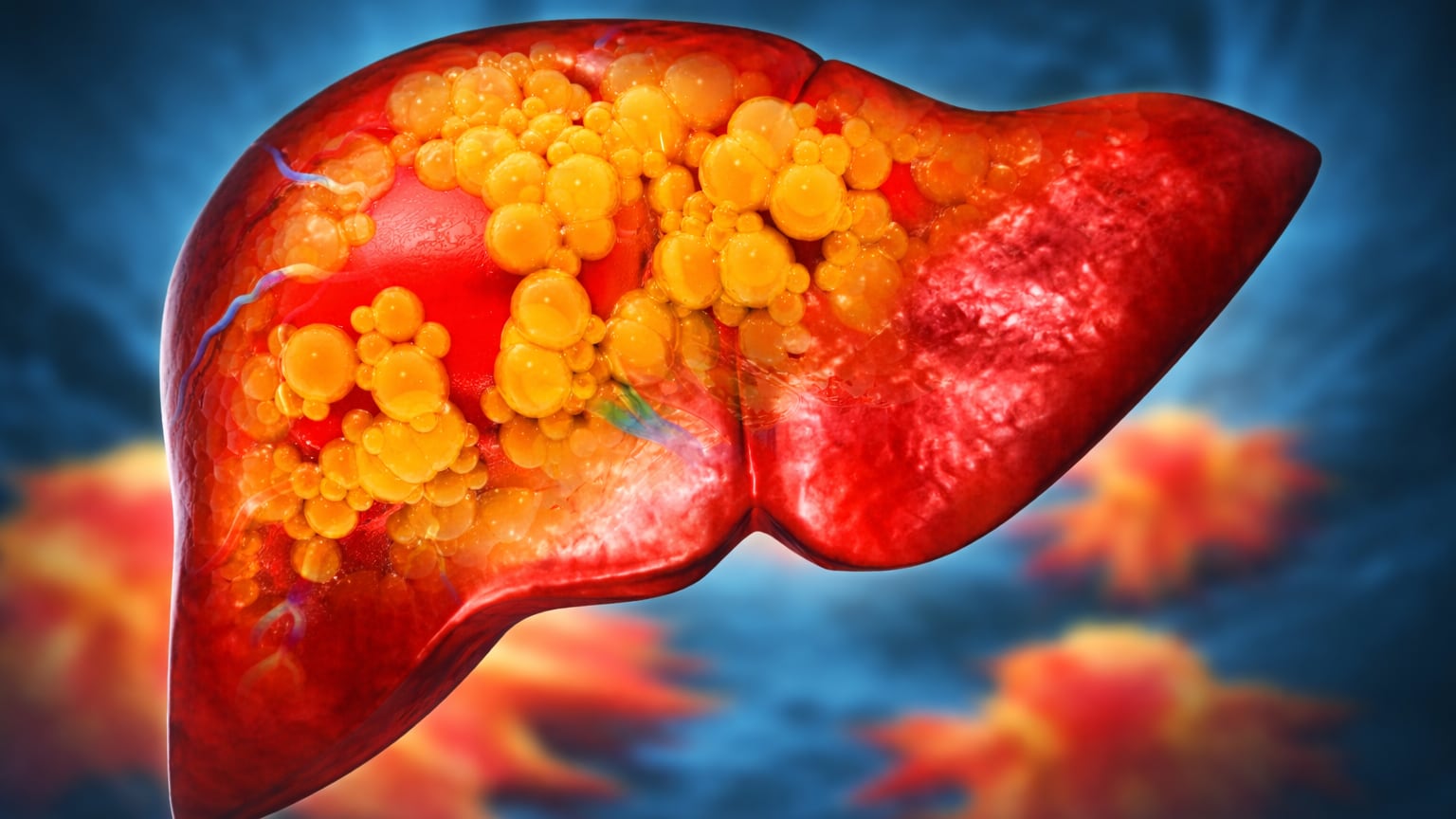 El consumo excesivo mensual de alcohol triplica el riesgo de fibrosis hepática en personas con enfermedades metabólicas como obesidad o diabetes (Imagen Ilustrativa Infobae)